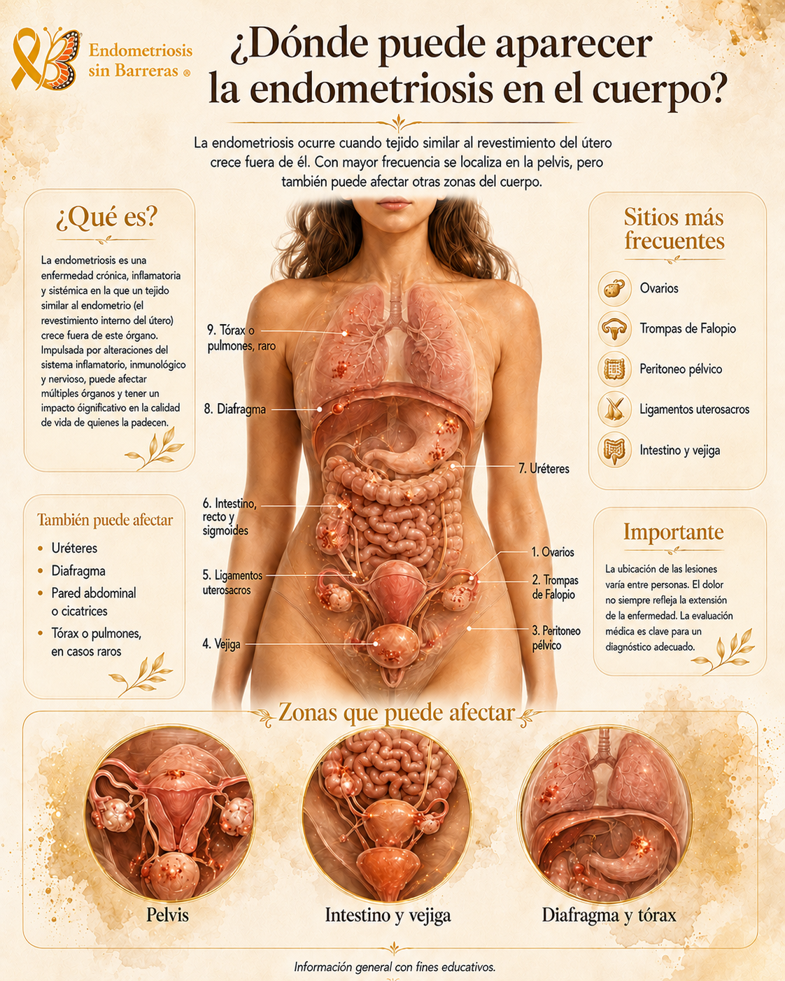 Infografía: ¿Dónde puede aparecer la endometriosis en el cuerpo?
